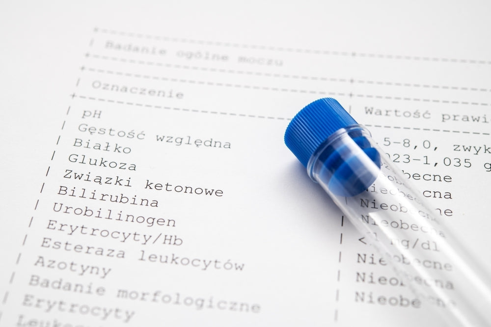 Urinalysis test report with blue-capped specimen tube, medical diagnostics concept