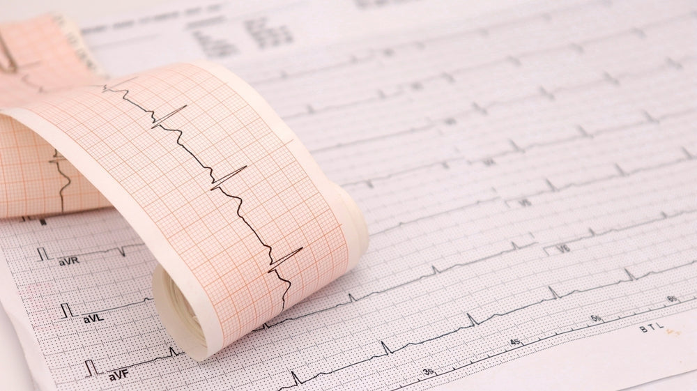 ECG printouts displaying heart monitoring results on medical graph paper